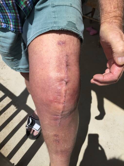 Mr Collins has about a 20cm long scar on his knee following the operation. Photo: Bronwyn Haynes.