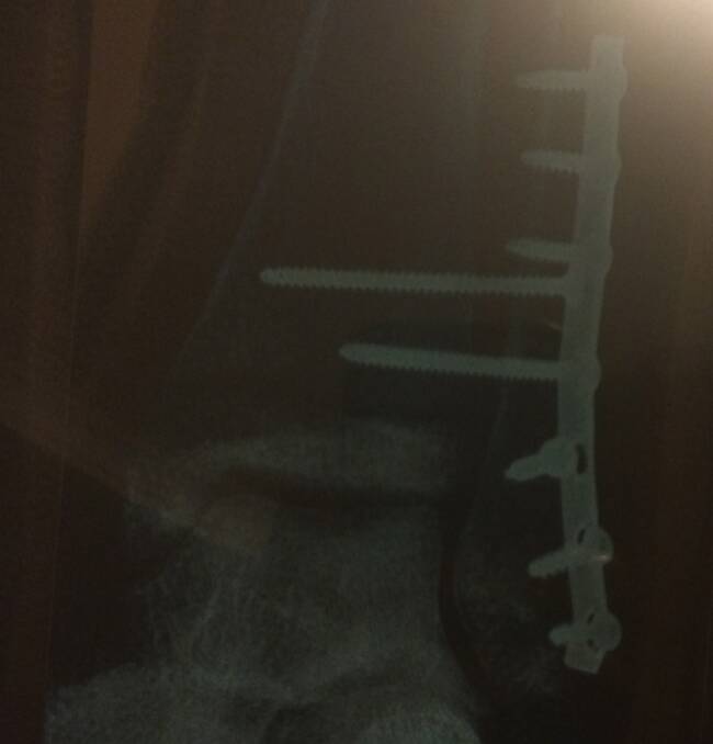 The eight screws and metal
plate that was drilled onto his left fibula
that has since been removed. Photo: Supplied.
