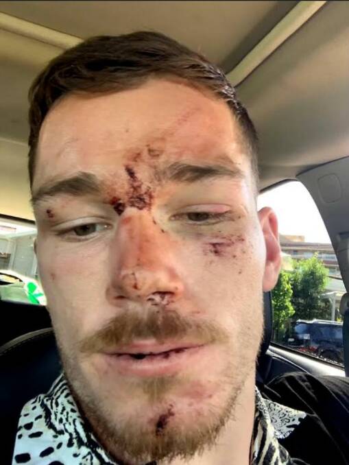 Tom Starling was left bloodied and bruised. Picture: Twitter