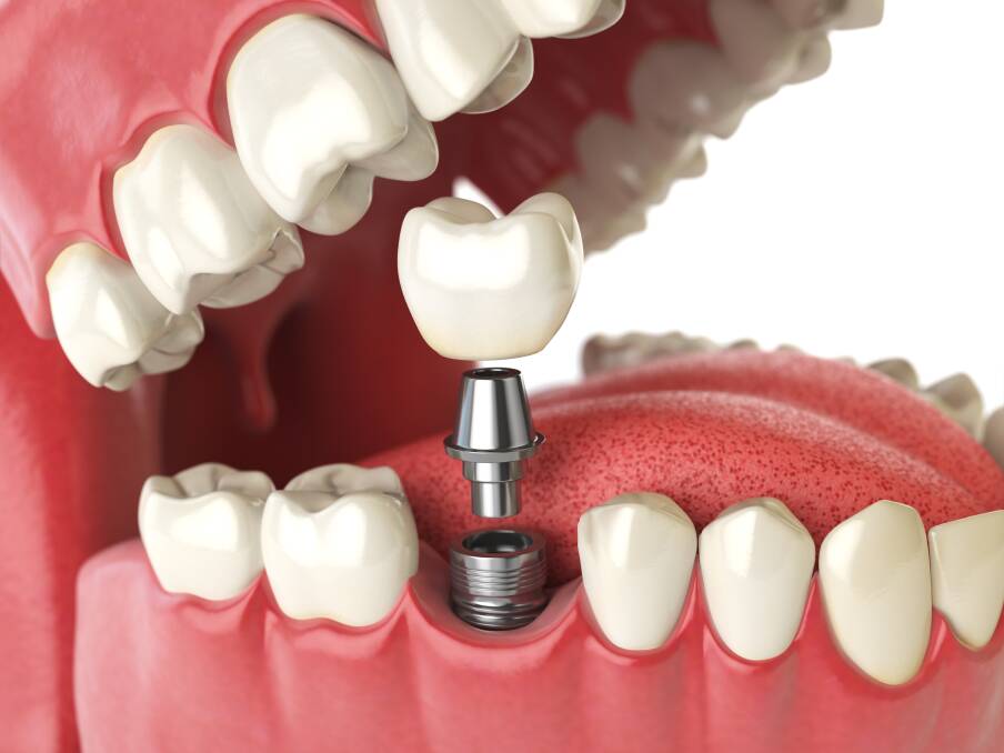 How to prep for a dental implant