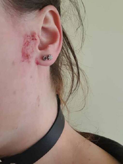 The wound on the side of Bree Bill's face inflicted by the swooping magpie on Monday.